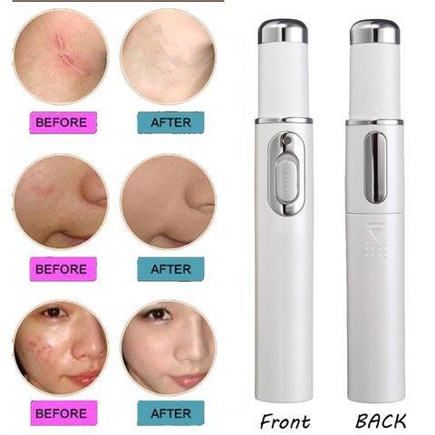 Blue Light Therapy Acne Laser Pen Soft Scar Wrinkle Removal Treatment Device Skin Care Beauty Equipment - Image 5
